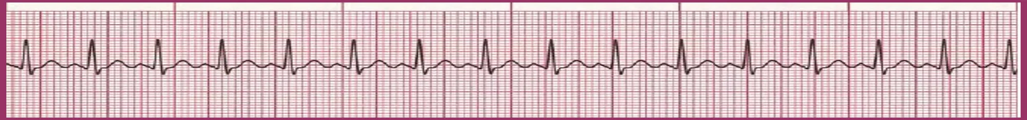 Slayt 17 EKG şeridi