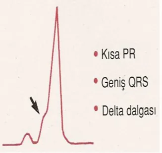 Kısa PR, geniş QRS, delta dalgası